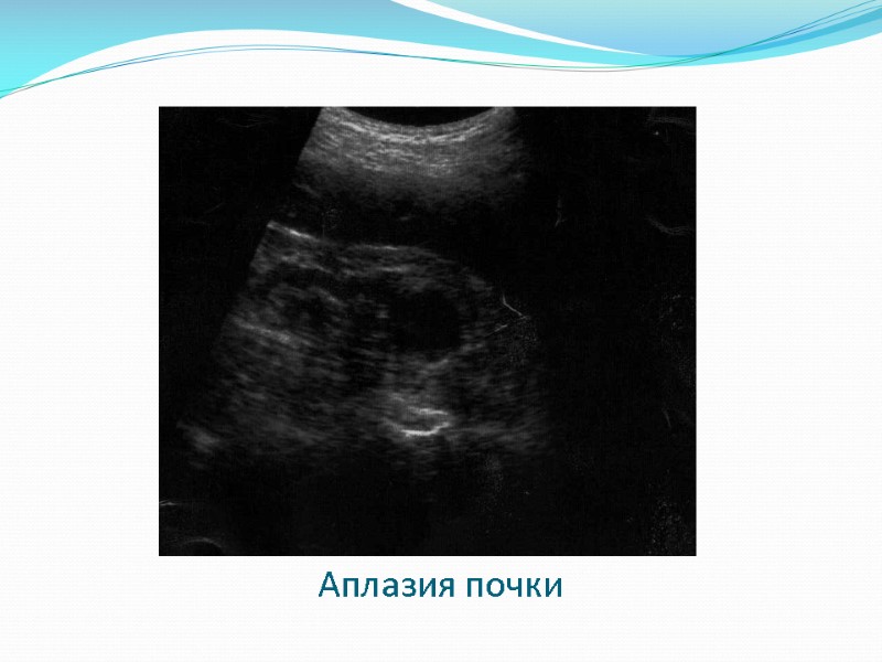 Аплазия почки